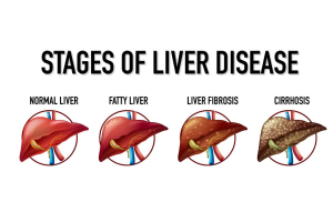 where to find fatty liver disease medicine online, online pharmacy, get fatty liver disease medicine online, fatty liver disease treatment, liver disease medicine online home delivery, republic pharma, republic rxx, republic pharmaceutical