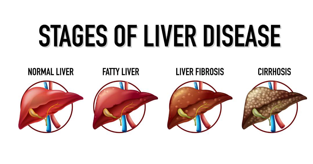 where to find fatty liver disease medicine online, online pharmacy, get fatty liver disease medicine online, fatty liver disease treatment, liver disease medicine online home delivery, republic pharma, republic rxx, republic pharmaceutical